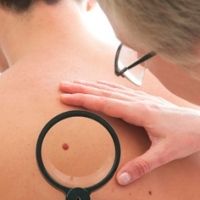 Жителей Крюково приглашают на обследование в День диагностики меланомы